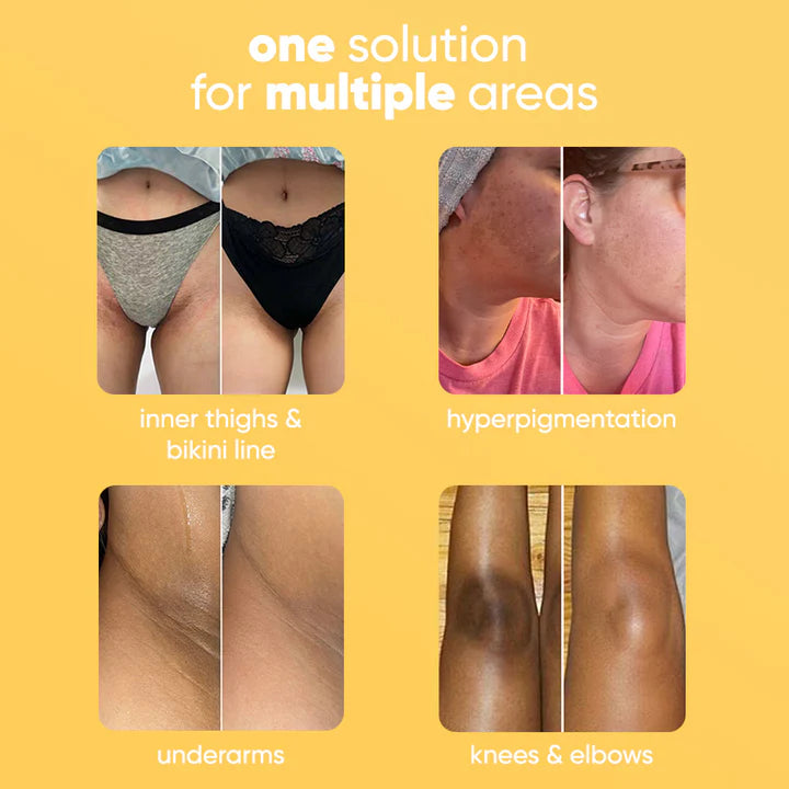 Handmade Lemon Turmeric Kojic Acid Soap - Gentle Dark Spot Remover for Acne & Hyperpigmentation